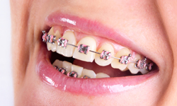 What Are Lingual Braces and How Do They Work? - FitSmiles